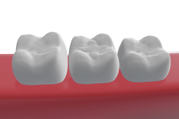 How Cosmetic Dentistry Uses Tooth Colored Fillings
