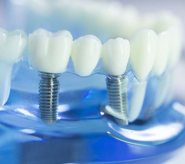 Woodland Hills Dental Implants