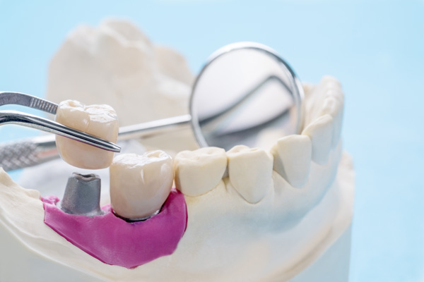 Implant Crowns Vs  Traditional Crowns: Key Differences Explained