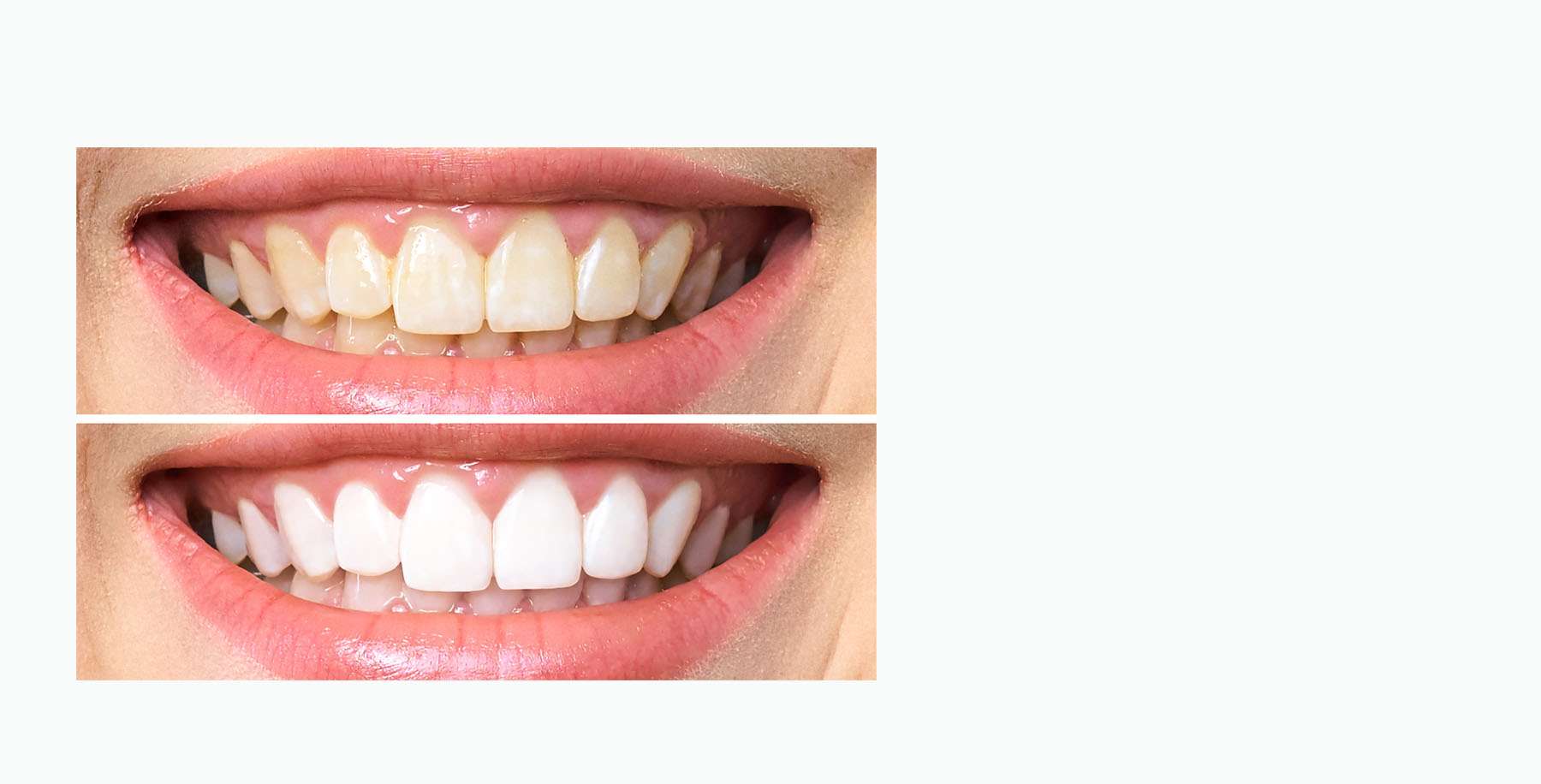 Teeth Whitening