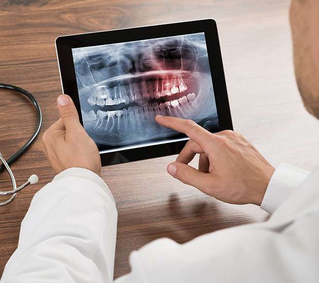 Woodland Hills Types of Dental Root Fractures